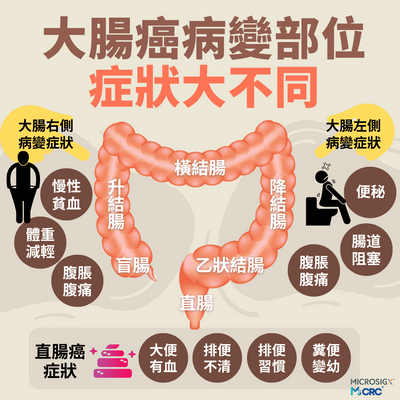 大腸癌病變部位 症狀大不同